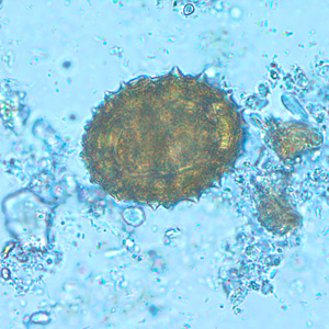 November - 2007 - Case #216 An asymptomatic, 35-year-old male with no known travel history went to his physician at a wellness clinic for a routine examination. Unusual objects were observed in the formalin-concentrated stool, and the specimen was sent to CDC for diagnostic assistance and possible identification.