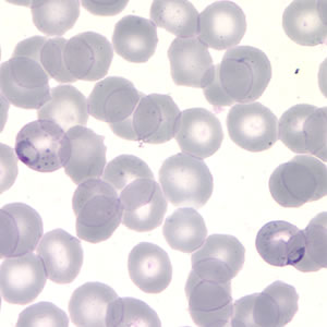 A 29-year-old man, with a history of travel to Rwanda, was seen at a local health clinic for fever, headache, mild nausea, and chills. 