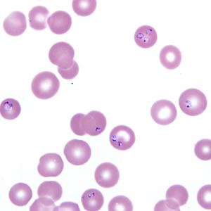 December - 2007 - Case #218 A 52-year-old man was seen at a hospital for fever and chills. He reported travel to wooded areas in the Northeastern United States and noted previous tick bites.