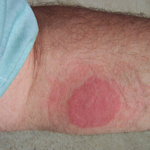 January - 2008 - Case #219 Five hunters spent a weekend in a cabin in the Northeastern United States. One of the hunters, who slept in a sleeping bag on the floor of the cabin, awoke in the morning with a rash on various parts of his body (Figure A).