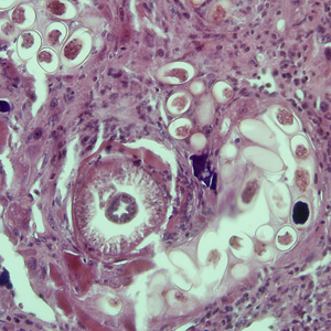 April - 2008 - Case #225 An 8-year-old child was taken to a hospital with fever, hepatomegaly, and persistent cough. The parents told the physician that the child commonly eats dirt, even though they have tried to discourage the habit.
