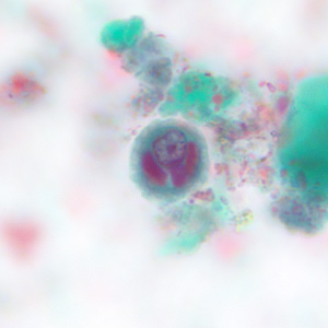May - 2008 - Case #228 Within a week of returning from a conference in Mexico, a 28-year-old woman presented to her primary care physician with cramps, abdominal pain, gas and diarrhea. A routine Ova and Parasite (O&P) examination was performed on stool specimens.