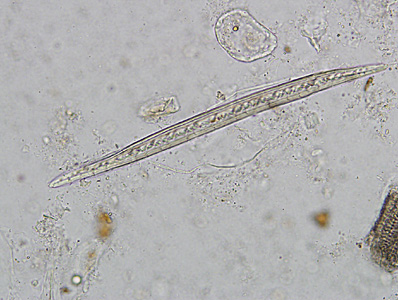 A 29-year-old man presented to his physician with recurring abdominal cramping, watery diarrhea, and general fatigue. A stool specimen was collected for ova and parasite testing. 