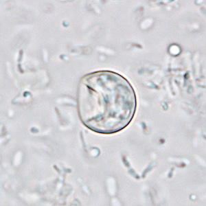 August - 2008 - Case #233 A 37-year-old man began experiencing severe diarrhea about one week after attending a family social event. At the request of his medical provider, a fecal specimen collected in the two-vial system consisting of one vial with 10% formalin and one vial with Zn-PVA (zinc-based polyvinyl alcohol) was submitted for examination.