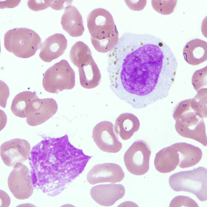 October - 2008 - Case #238 A 45-year-old man from Kenya who was visiting relatives in the New England area had complaints of fever and headache. He was taken to a nearby hospital for medical evaluation.