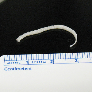 December - 2008 - Case #241 A small, cream-colored worm-like object was discovered in the diaper of a 15-month-old child. The suspect worm was collected by the child’s parents and sent to the State Health Department for identification.