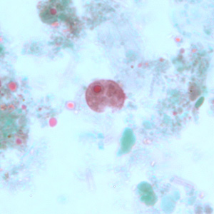 A ten-year-old child returned from summer camp with abdominal discomfort, nausea and diarrhea. He was taken to his pediatrician and a stool specimen was collected for routine work-up, including ova and parasite (O&P) examination. 