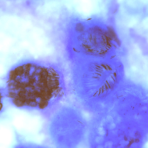 March - 2009 - Case #247 A patient, originally from Ethiopia but living in the United States for the past five years, presented to her primary care provider with complaints of abdominal pain. A computed tomography (CT) scan was performed, and cysts were observed in the liver.