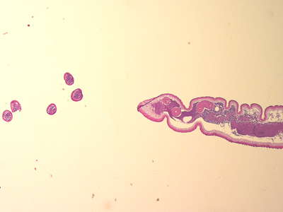 A 36-year-old immigrant from Mozambique presented to his health care provider with heartburn and chronic right abdominal pain. All previous ova and parasite (O&P) examinations were negative. 