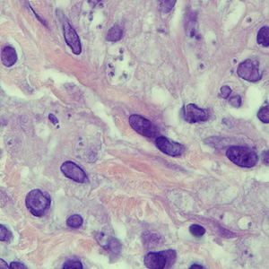 April - 2009 - Case #250 A 45-year-old man developed a few ulcerative lesions on his left forearm about one month after returning from a nature excursion in Costa Rica. He was referred to an infectious disease specialist by his primary care provider.