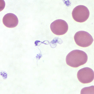 June - 2009 - Case #254 A 37-year-old man traveled to Senegal and The Republic of Gambia for two months. Upon his return, he went to his health care provider with complaints of fatigue, headache and fever.