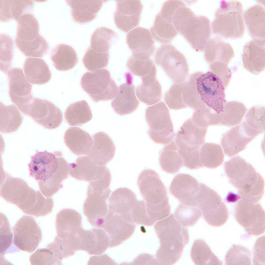 A 36-year-old man was admitted to the hospital with fever, chills, headache, and myalgia. The patient recently returned to the United States following a month-long trip to Rwanda to visit family. 