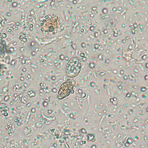 A 25-year-old refugee from Myanmar was screened for parasites at a local clinic in Tennessee. Stool specimens were collected in 10% formalin and polyvinyl alcohol (PVA) and sent to the state health laboratory for ova and parasite (O&P) work-up. 