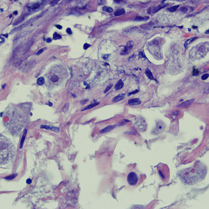 August - 2009 - Case #258 A biopsy was performed on a 23-year-old woman with no known travel history, presenting with a perianal ulcer. The specimen was preserved in formalin and sent to a pathology lab for work-up.