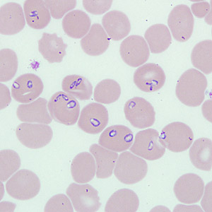 A 70-year-old man from the mid-western United States had complaints of fever and general malaise lasting for about one week. He was admitted to a hospital with evidence of hemolytic process (dark urine and low hemoglobin). 