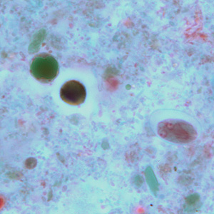 A five-year-old child went to a local clinic with complaints of abdominal cramping, excessive gas, diarrhea, and weight loss. Stool specimens were collected in formalin and polyvinyl alcohol (PVA) and sent to the local public health laboratory for routine ova-and-parasite (O&P) examination. 