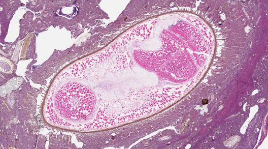 A 13-year-old patient went to the doctor for abdominal pain and discomfort. Although there was no acute appendicitis, a small biopsy of the lumen of the appendix was performed to identify possible etiologies. 