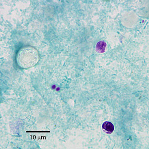 A 29-year-old woman had complaints of abdominal cramping and diarrhea that had been persisting for 5 days. She went to a local clinic to determine what was causing her illness.