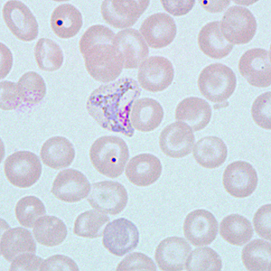 The DPDx Team received Giemsa-stained blood smears from a state health laboratory for malaria confirmation/identification. The patient travels internationally regularly for business, and within the month before becoming ill, had traveled to India, Malaysia and China.