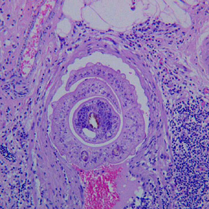 A 35-year-old male from the United Arab Emirates was hospitalized with complaints of upper and lower abdominal pain. Sections of the greater omentum and appendix were biopsied and sent to a pathology laboratory for sectioning and staining. 