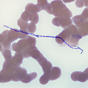 A patient from Pakistan was admitted to a medical facility with non-cirrhosit portal hypertension, hepatic vein thrombosis, IVC stenosis and respiratory failure. No eosinophilia was reported at the time patient was admitted, but was present at 7% the next day. 