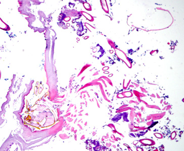 May - 2010 - Case #275 A 70-year-old female, who had recently returned from a trip to Madagascar, went to the hospital for a painful sensation on the underside of her left foot while walking. Examination of the area between the hallux and index toes revealed an ulcerative lesion.
