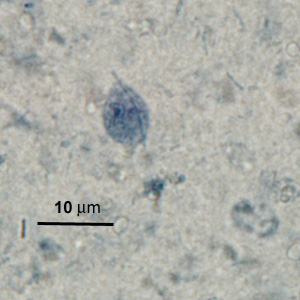 May - 2010 - Case #276 The DPDx Team received stained stool smears from the Vermont Department of Health Laboratory for Entamoeba identification. The patient was a 12-year-old refugee from Myanmar who had also traveled to Malaysia.
