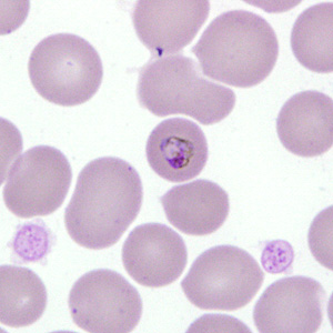 A 29-year-old female went to her health care provider with complaints of fever and headache, two weeks after returning home from trips to Uganda and Sudan. She admitted that she only took malaria prophylaxis whenever she did not feel well. 