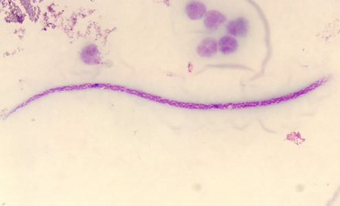 While examining a malaria-positive smear on a patient from Uganda, microbiologists at the Ontario Agency for Health Protection and Promotion observed what they believed to be a microfilaria. Images were captured and sent via email to the DPDx Team for diagnostic assistance. 