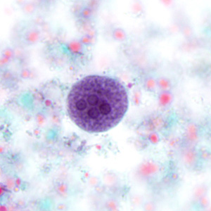 July - 2010 - Case #280 A 35-year-old woman went to her health care provider with complaints of abdominal pain, cramps and diarrhea. She told her doctor that she had recently returned from a business trip to Mexico. Stool was collected in 10% formalin and polyvinyl alcohol (PVA) for routine ova-and-parasite (O&P) examination.