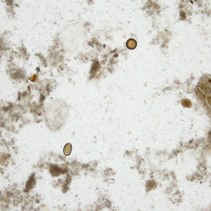 A 25-year-old man, who lives in the Midwestern United States, went to his health care provider with complaints of abdominal pain over the last month. A stool specimen preserved in 10% formalin was submitted for ova-and-parasite (O&P) testing. 