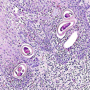 September - 2010 - Case #283 A 49-year-old man presented to his primary care physician with a lump in his throat which had developed over the past three months. He was ultimately referred to an oral surgeon with multiple oral ulcers and submucosal nodules.