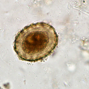 A 10-year-old immigrant from Haiti was screened for parasites at a refugee screening clinic. Stool specimens were collected in 10% formalin and polyvinyl alcohol and sent to the local state health laboratory for testing. 