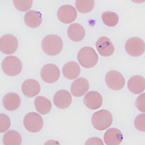 A 29-year-old pregnant woman from Ethiopia presented to a hospital with nausea, vomiting, abdominal pain and episodic fever. The symptoms started within a day after arriving in the United States, and had persisted for five days prior to hospitalization.
