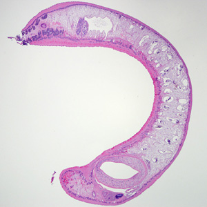 November - 2010 - Case #288 A 50-year-old man underwent a screening colonoscopy after complaints of constipation. A polyp measuring approximately 3 mm was observed during the procedure.