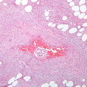 December - 2010 - Case #289 A 47-year-old woman originally from El Salvador had been living in Minnesota for 16 years. She visited family in El Salvador for about a month during the summer. One month after returning to Minnesota, she was admitted to a local hospital for an appendectomy.