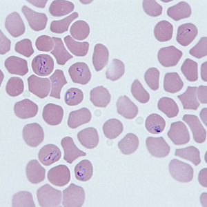 A 31-year-old man was admitted to a local hospital with fever, chills, myalgia, and fatigue. His travel history included a two week work-related trip to Cambodia and a one week vacation in Connecticut immediately after that trip. 