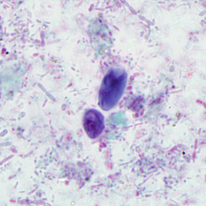 A seven-year-old child was taken to the doctor for abdominal pain, gas, bloating and intermittent diarrhea. The symptoms started about two days after returning from summer camp. 