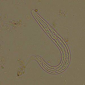 February - 2011 - Case #294 A 45-year-old woman, originally from Africa, presented to her primary care provider with diarrhea, nausea, vomiting, weight loss and gastritis. The symptoms occurred approximately three months post kidney transplant.