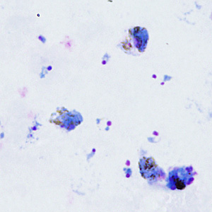 A hospital laboratory sent a tube of EDTA blood and Wright-Giemsa stained blood smears (thick and thin) to the DPDx Team for malaria confirmation/identification. No travel history was available. 
