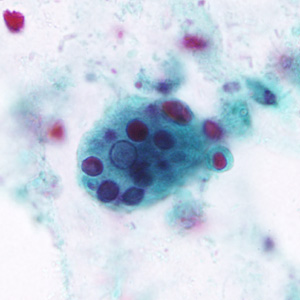 March - 2011 - Case #296 A 30-year-old man presented to his primary care provider with abdominal pain, fatigue, and diarrhea (sometimes tinged with blood). The patient had recently returned after two weeks in Armenia.