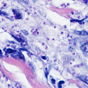 A 41-year-old woman presented to her health care provider with ulcerative lesions on her left ear and neck. Travel history included an excursion along the Amazon River in Brazil four months prior. 