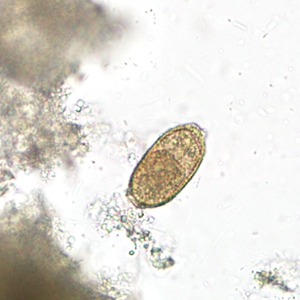 Stool specimens were collected for routine ova-and-parasite (O&P) examination by a local health department as part of a refugee screening program. Specimens were collected in 10% formalin and polyvinyl alcohol (PVA) and sent to the state health laboratory for processing and examination. 
