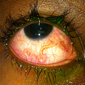 June - 2011 - Case #301 A 27-year-old male from Cameroon, who immigrated to the U.S. six years ago, presented to his health care provider with ocular pain and swelling. He told his health care provider that he had an episode of "a worm crawling in his eye" three years prior.