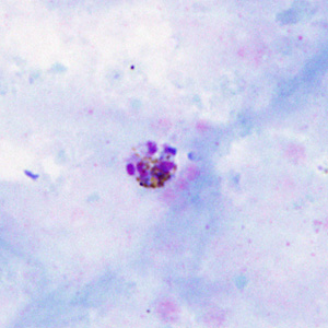 A 42-year-old man presented to his health care provider with fever, chills, and mild myalgia. He mentioned that his occupation requires frequent travel to Indonesia and Malaysia and that he often does not take any malaria prophylaxis. 