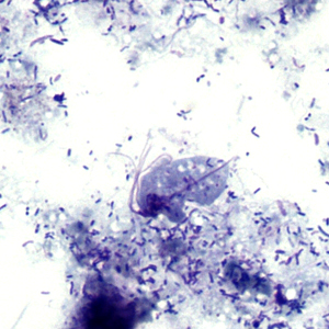 July - 2011 - Case #303 A 51-year-old man was brought to the emergency room after a friend noticed he was minimally responsive. The friend explained that the patient had been suffering from upper respiratory symptoms and mild fever for about three weeks, and a progressive cough for about one week.
