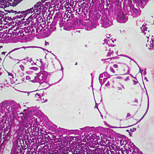 August - 2011 - Case #305 A twenty-year-old male from India presented with recurrent abdominal pain. He underwent an appendectomy at a local medical center.