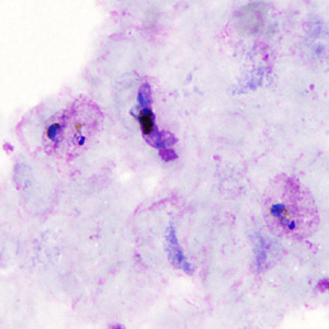 A 41-year-old woman from the Amazon region of Brazil presented at a local hospital with fever, chills, and myalgia. 