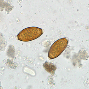 September - 2011 - Case #307 Stool specimens were collected from Haitian patients at a refugee clinic for routine ova-and-parasite (O&P) examination. The stool specimens were collected in 10% formalin and polyvinyl alcohol (PVA) and sent to the county public health laboratory for processing and examination.