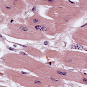September - 2011 - Case #308 A 27-year-old patient underwent chemotherapy and a bone marrow transplant after being diagnosed with leukemia. Approximately two months after the bone marrow transplant, the patient was admitted to the hospital.